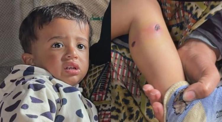 21-Month-Old Palestinian Toddler Returned with Burn Injuries After Israeli Detention